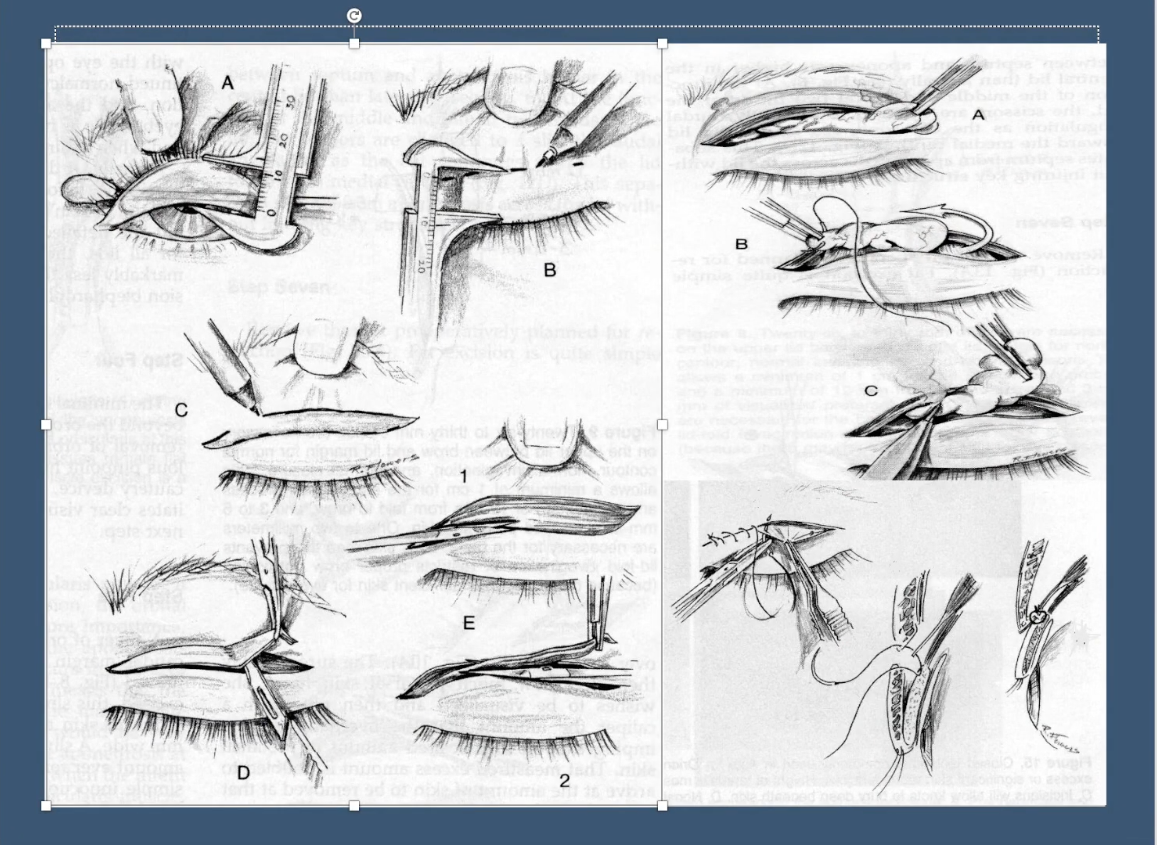 Blepharoplasty eyelid lift before and after