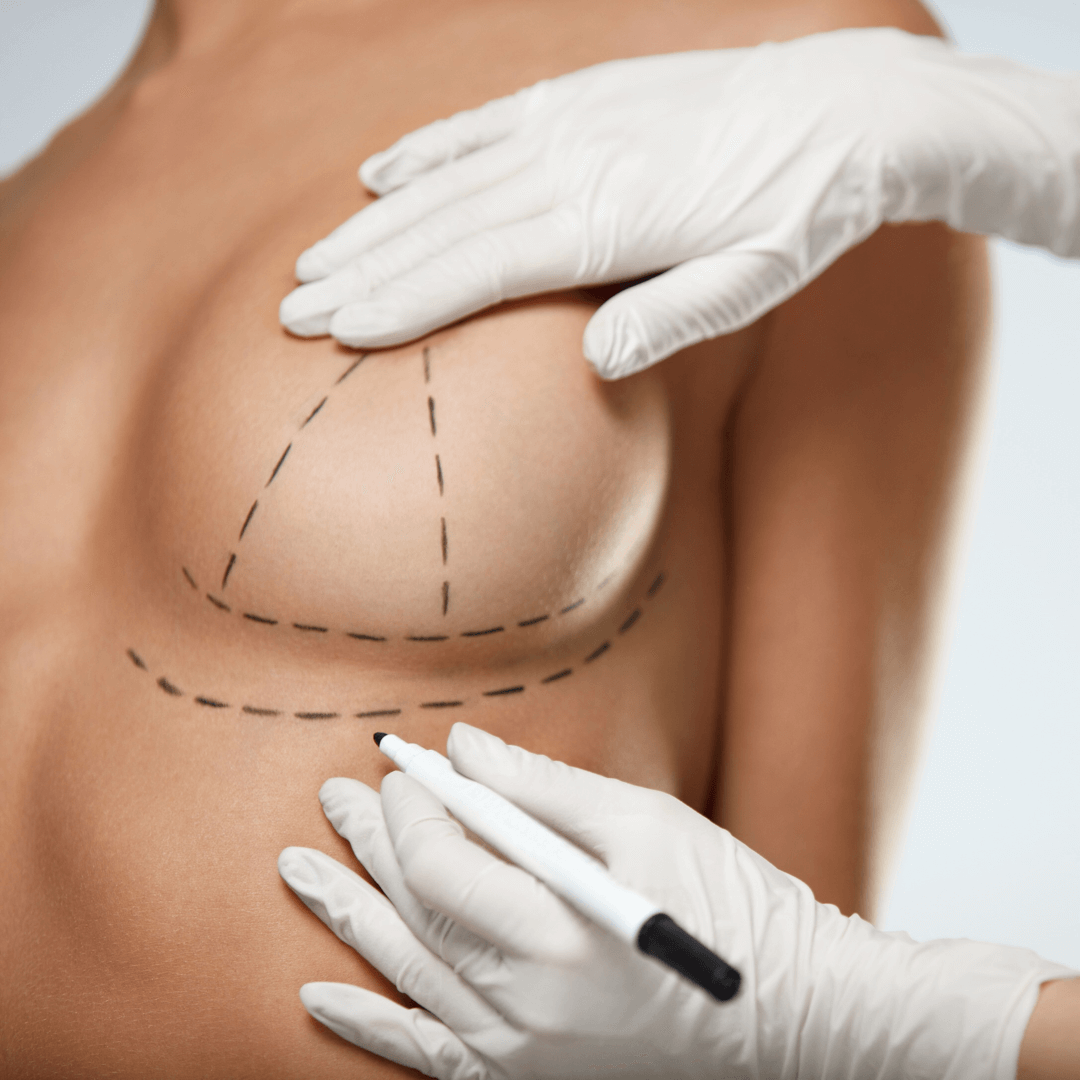 Breast bamlift surgery