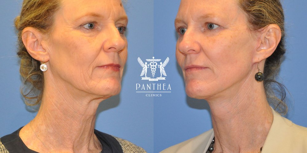 Neck Lift Cost Sydney How much does a neck lift